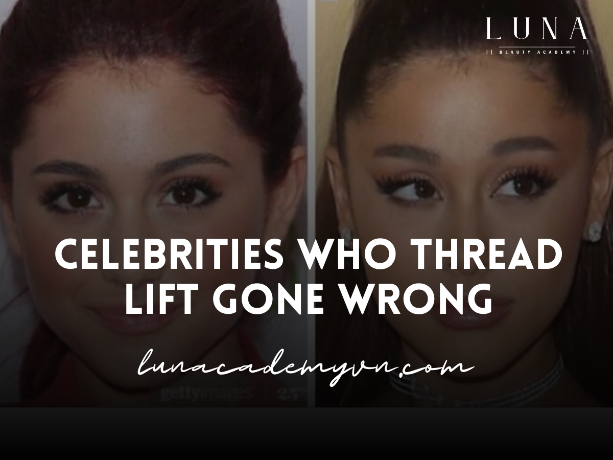 Celebrities Who Thread Lift Gone Wrong