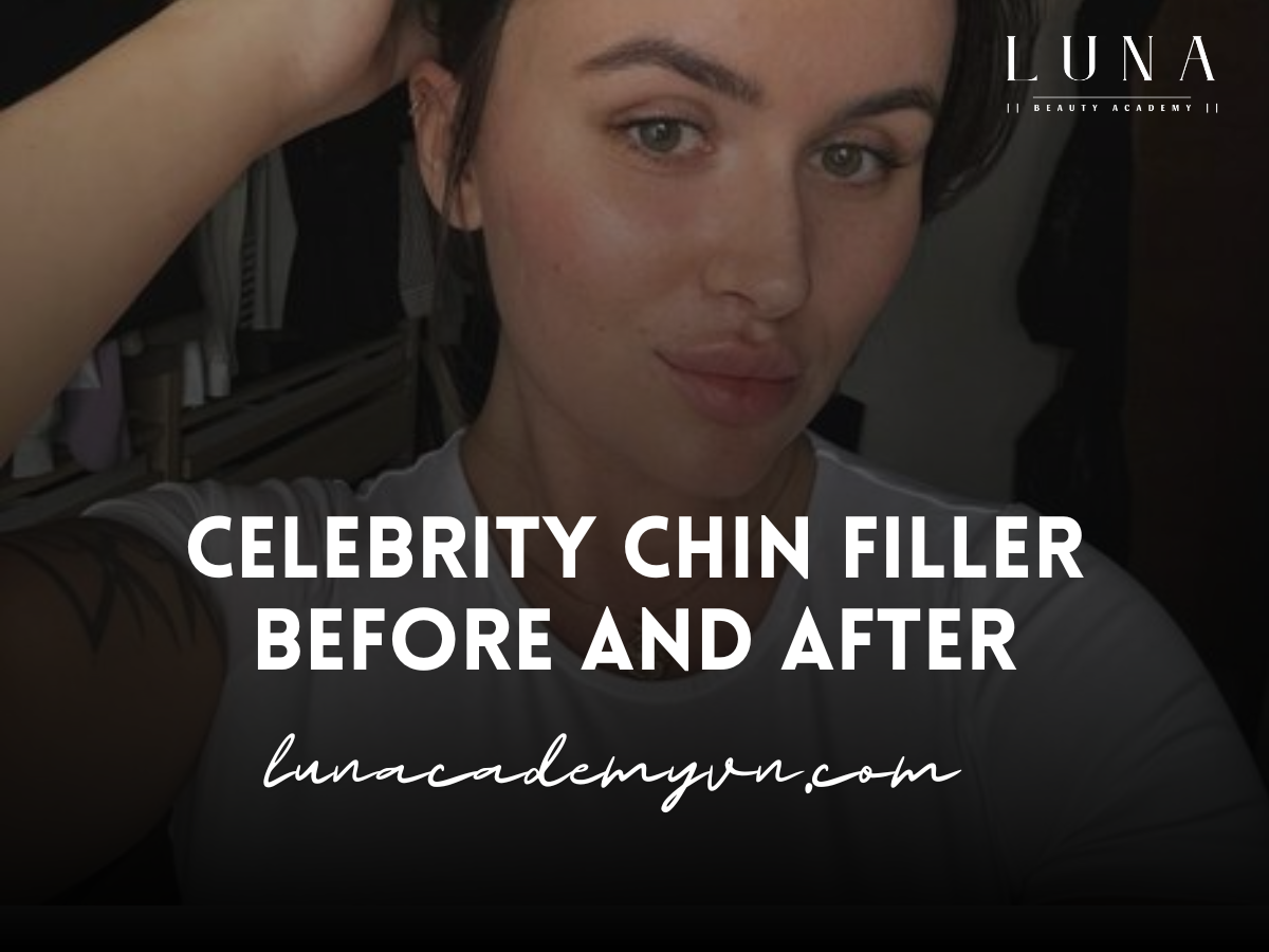 Celebrity Chin Filler Before and After