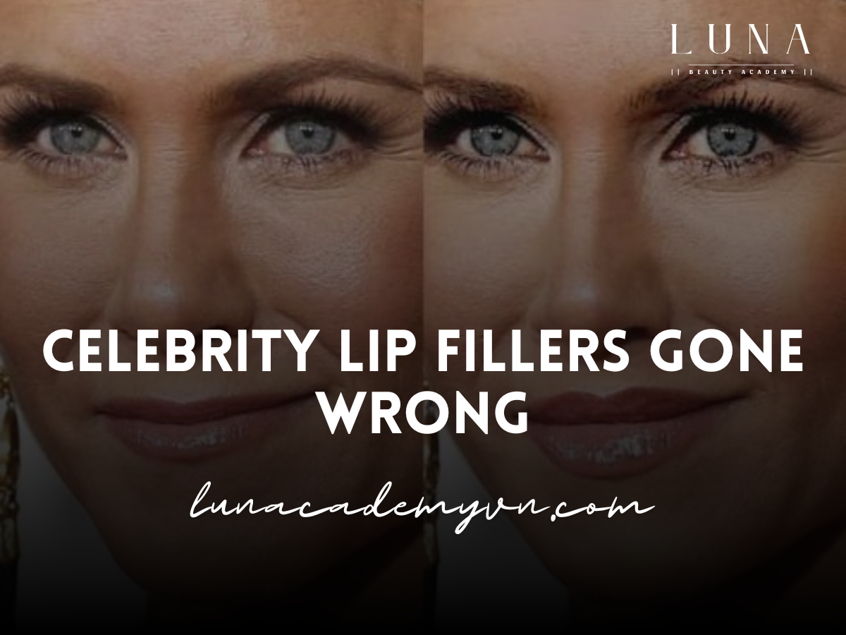 celebrity lip fillers gone wrong