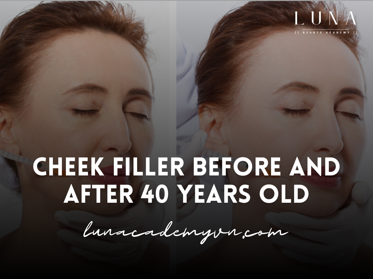 Cheek filler before and after 40