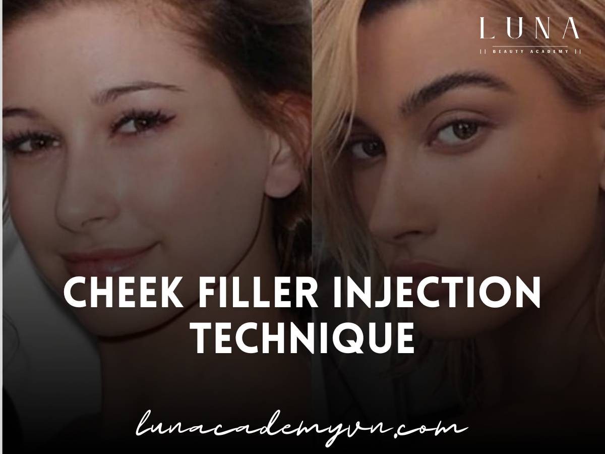 cheek filler injection technique