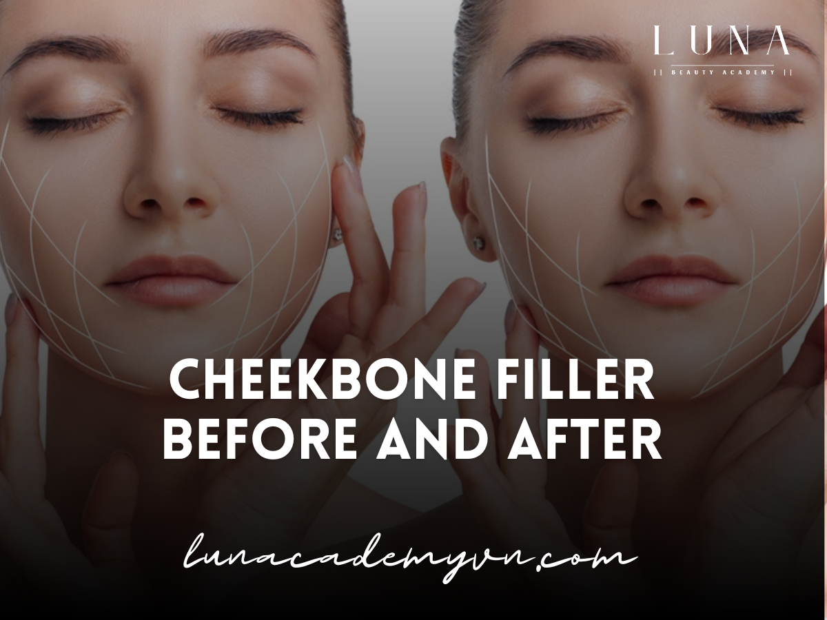 Cheekbone filler before and after