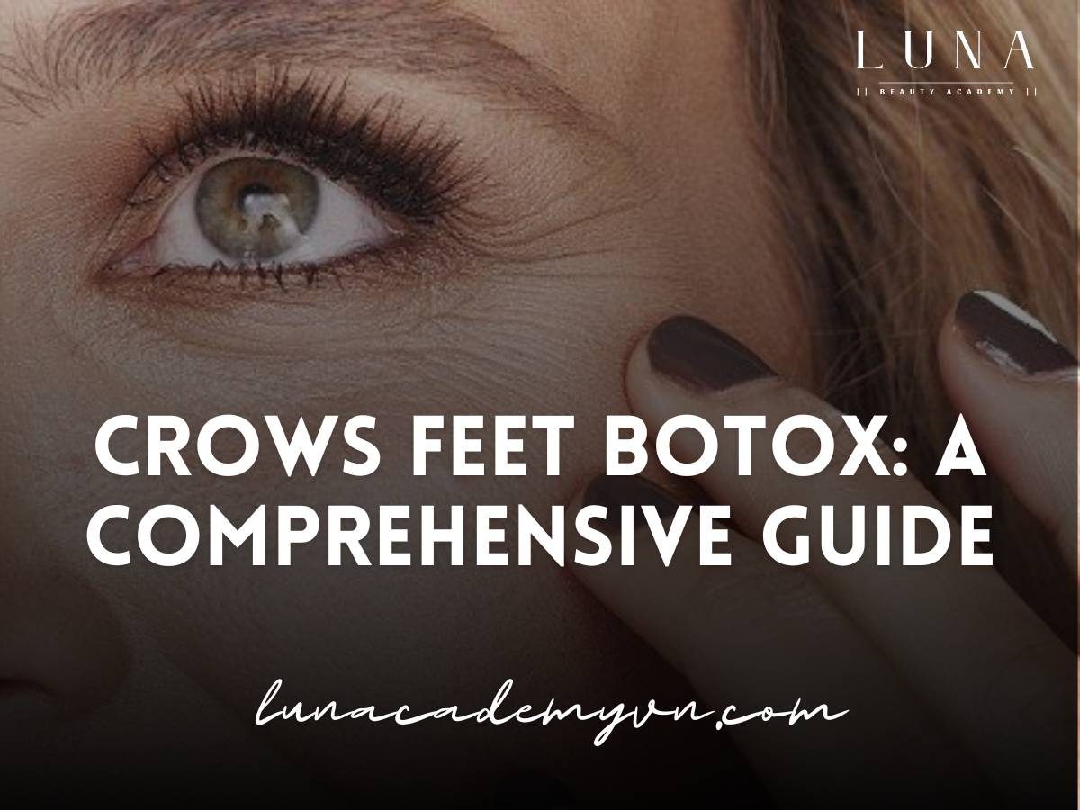 crows feet botox