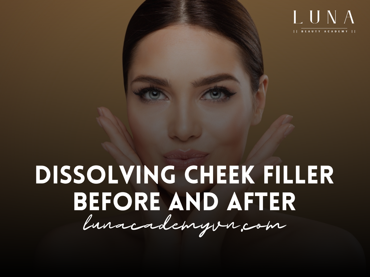 Dissolving cheek filler before and after