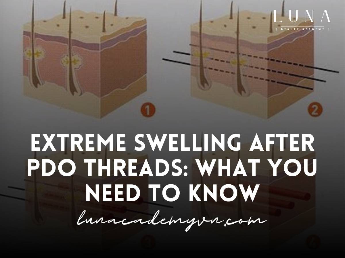 extreme swelling after pdo threads