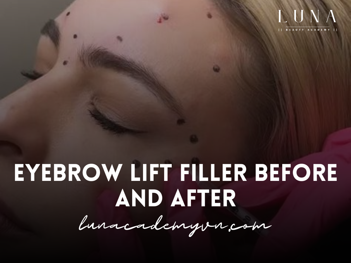 eyebrow lift filler before and after