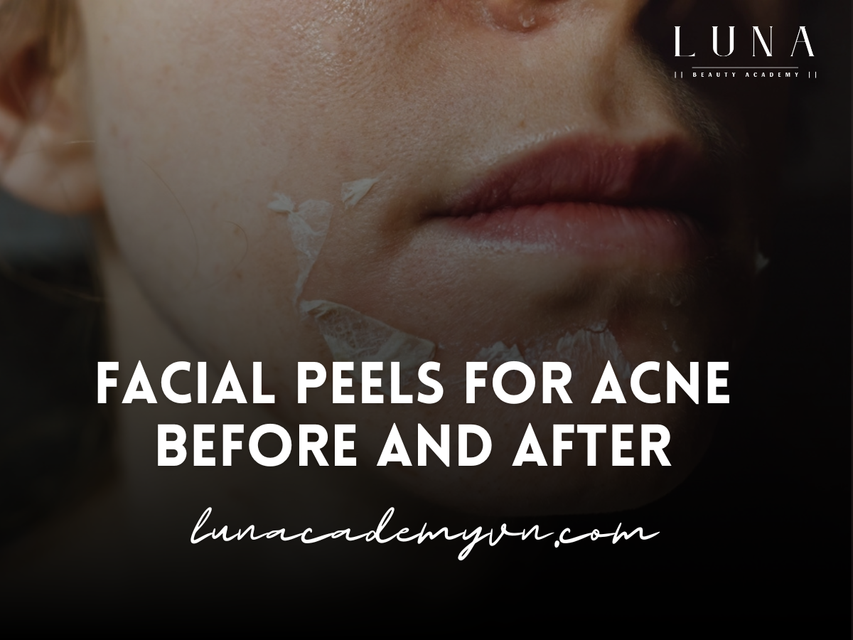 Facial Peels for Acne Before and After