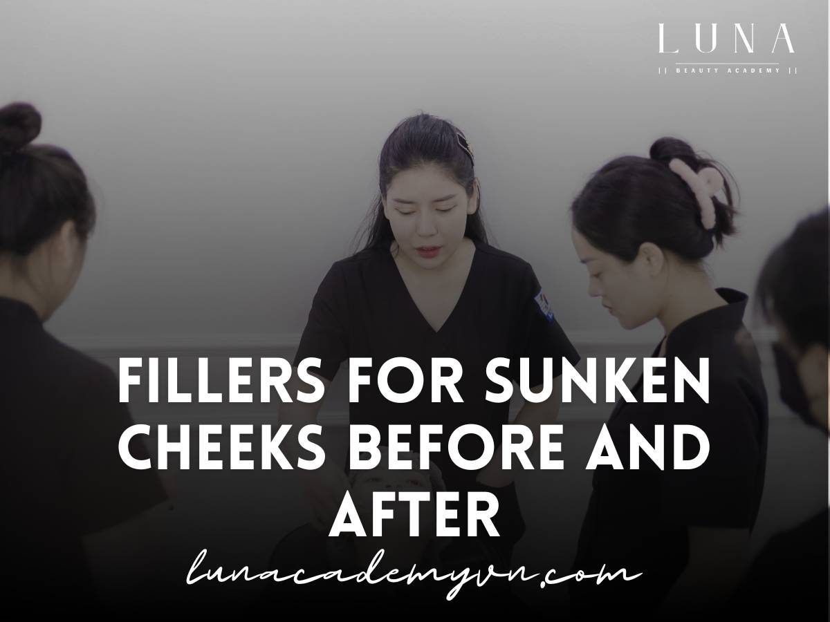 Fillers for sunken cheeks before and after