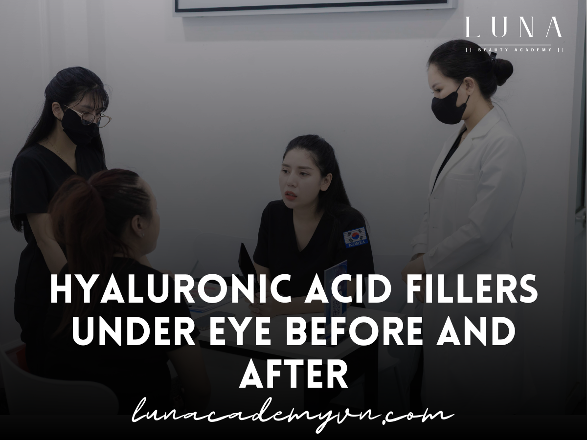 Hyaluronic Acid Fillers Under Eye Before and After