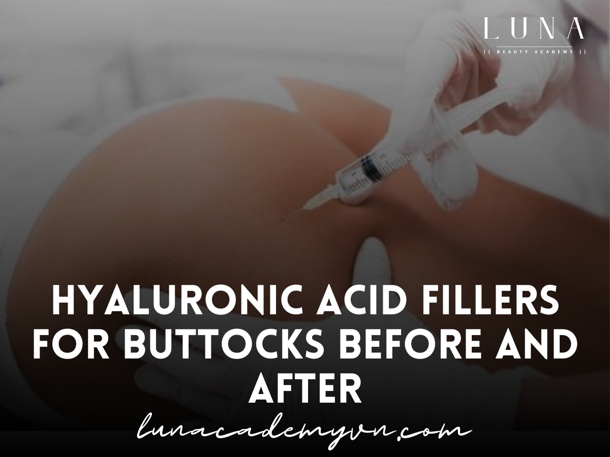 hyaluronic acid fillers for buttocks before and after