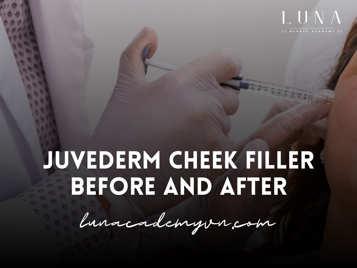 Juvederm Cheek Filler Before and After