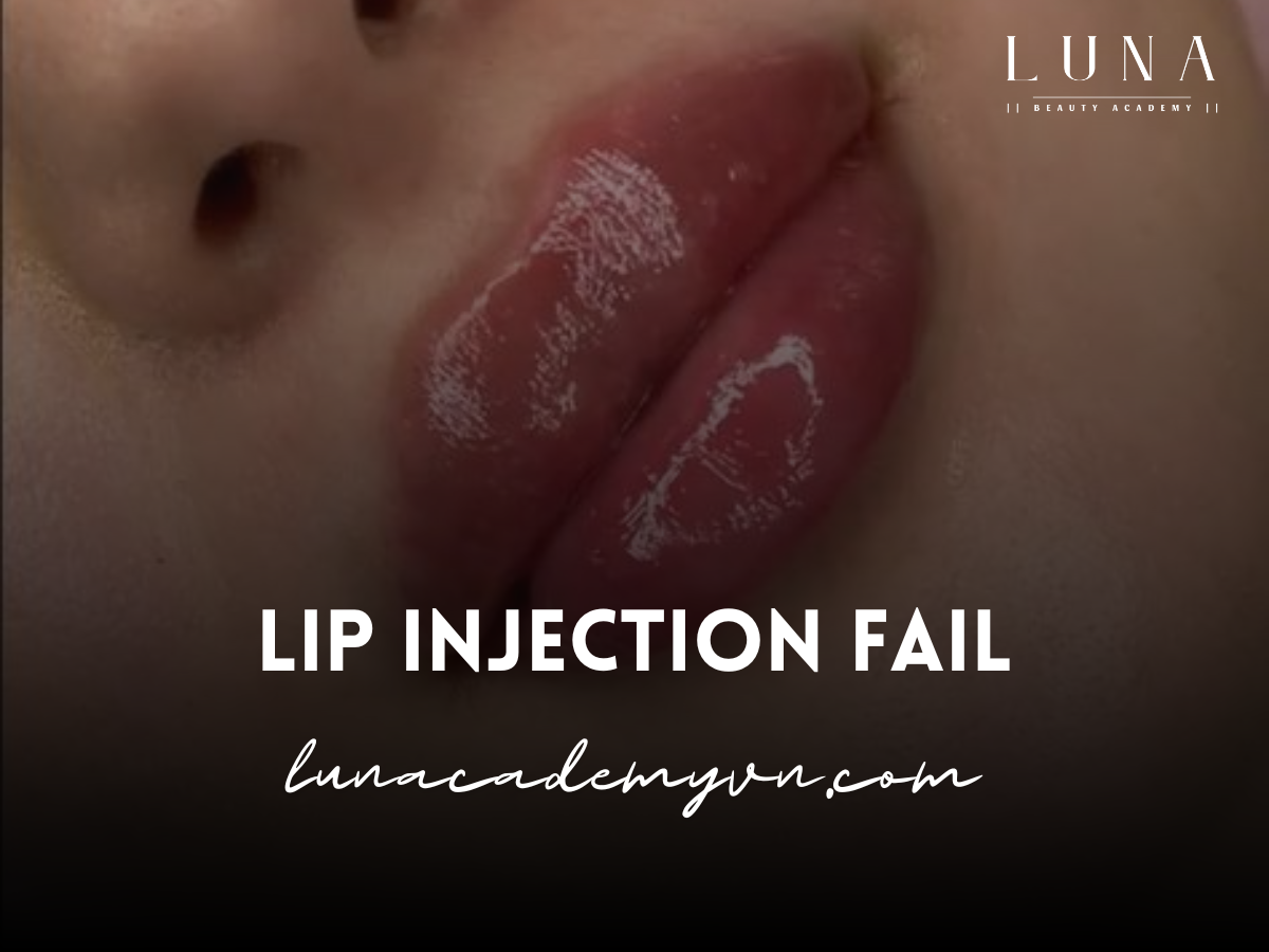 Lip Injection Fail