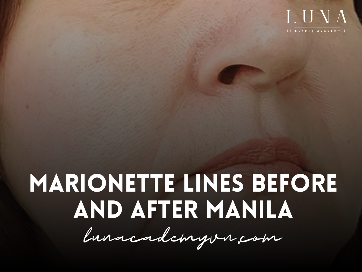 Marionette Lines Before and After Manila