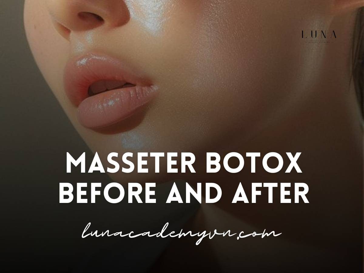 masseter botox before and after