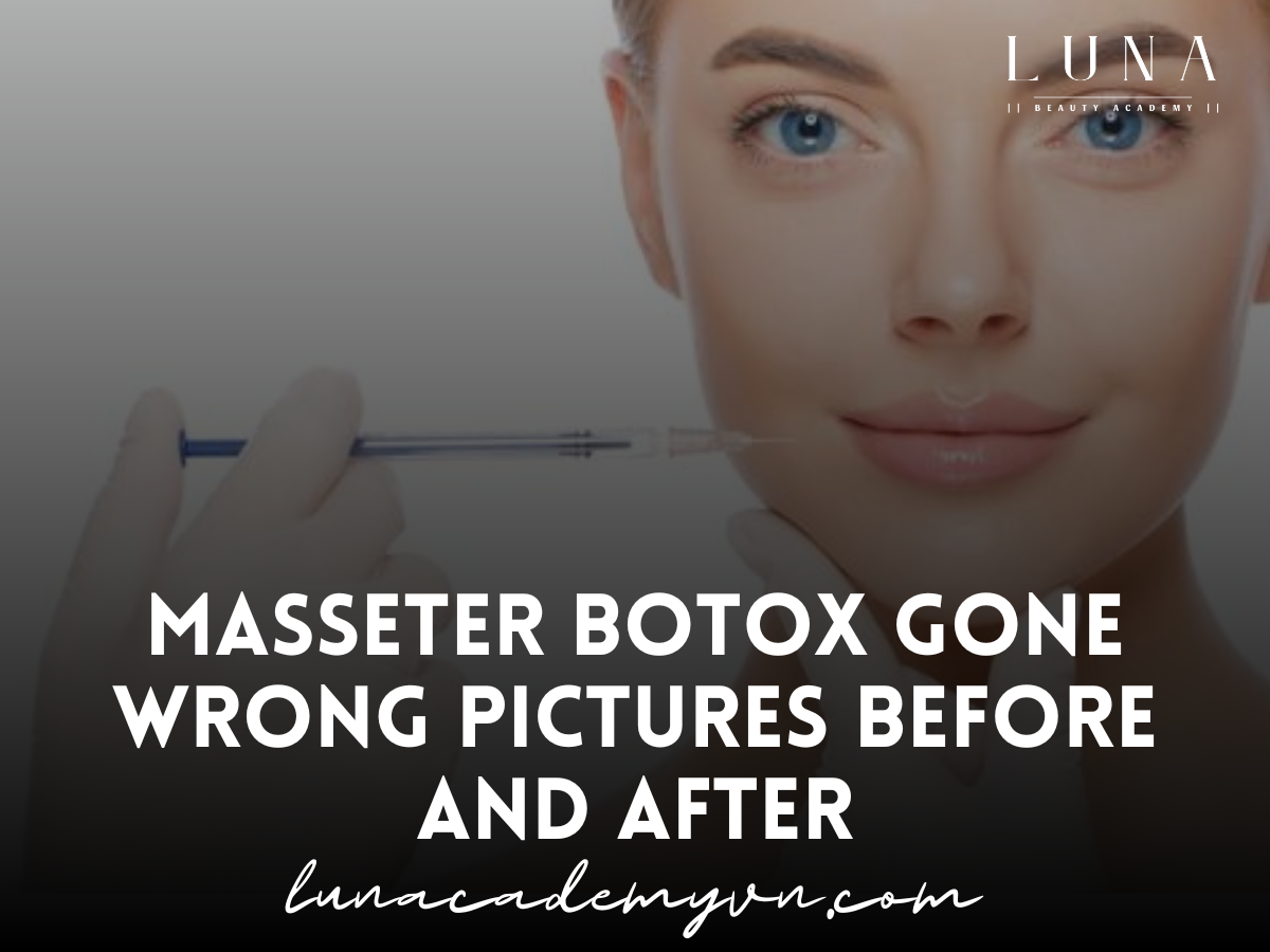 ﻿Masseter Botox Gone Wrong Pictures Before and After