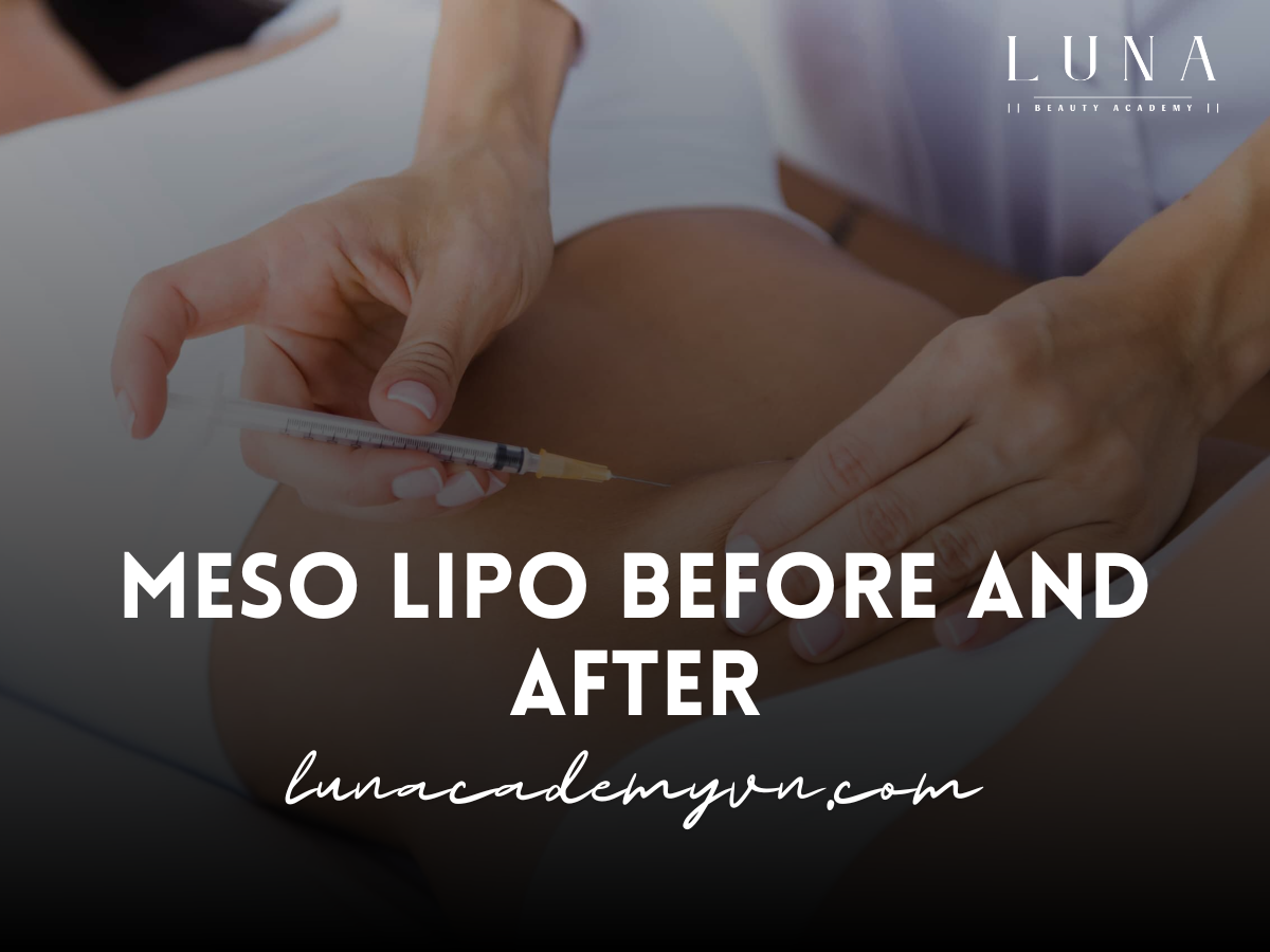 Meso Lipo Before and After