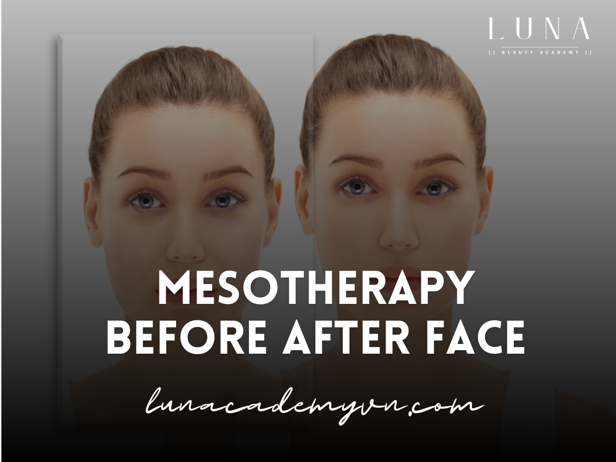 Mesotherapy Before After Face