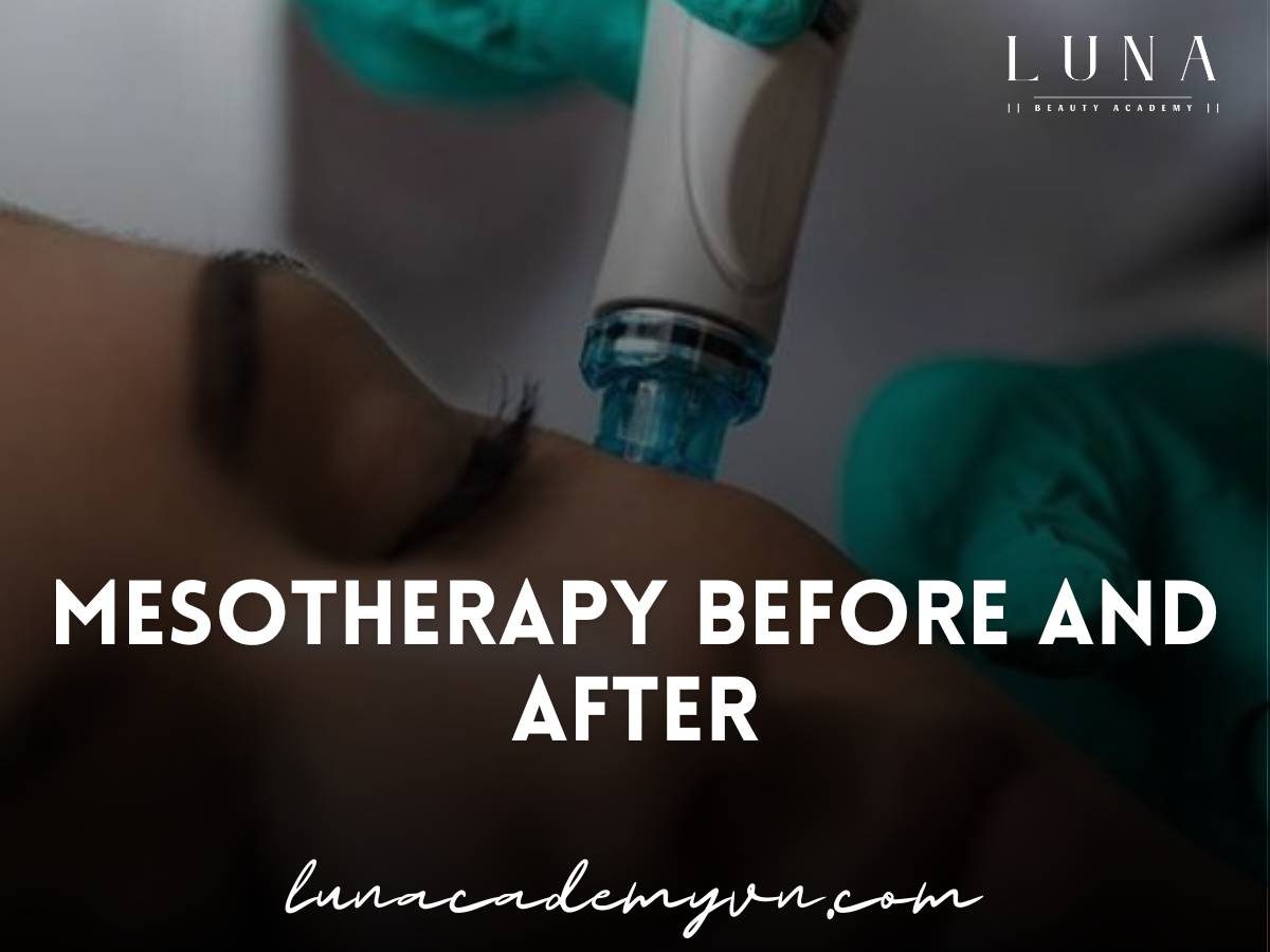 mesotherapy before and after