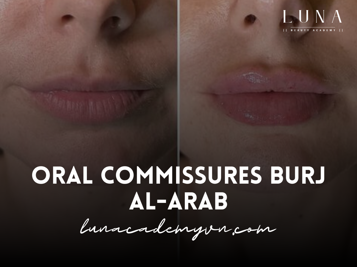 Oral Commissures Burj al-Arab: Aesthetic Solutions