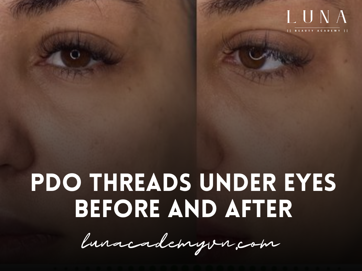 PDO Threads Under Eyes Before and After