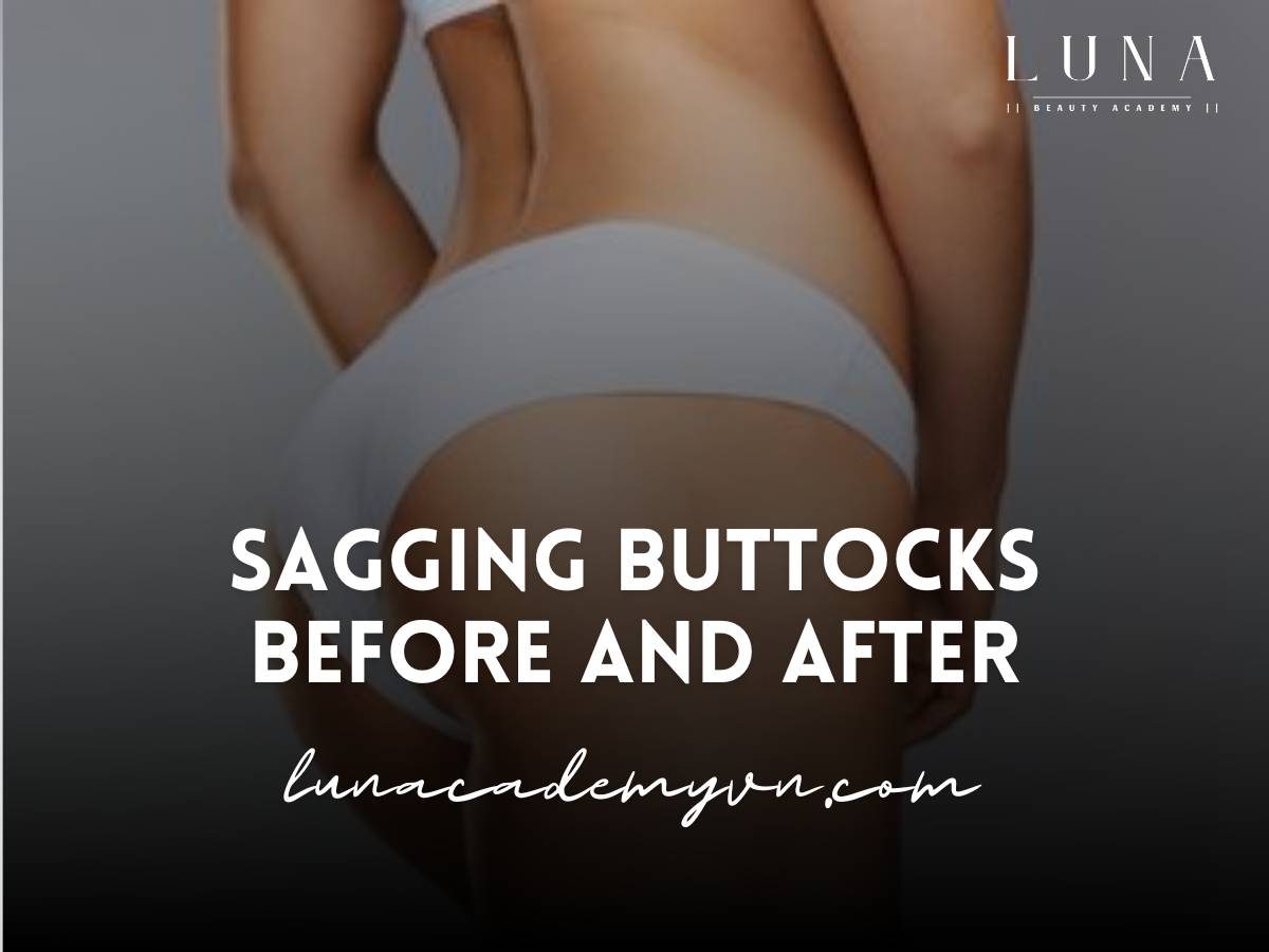 sagging buttocks before and after