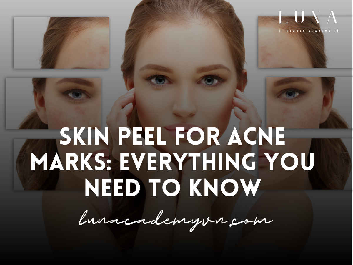 Skin Peel for Acne Marks