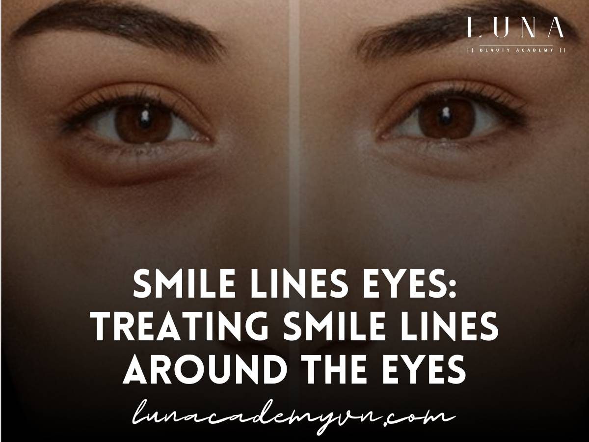 Smile lines eyes