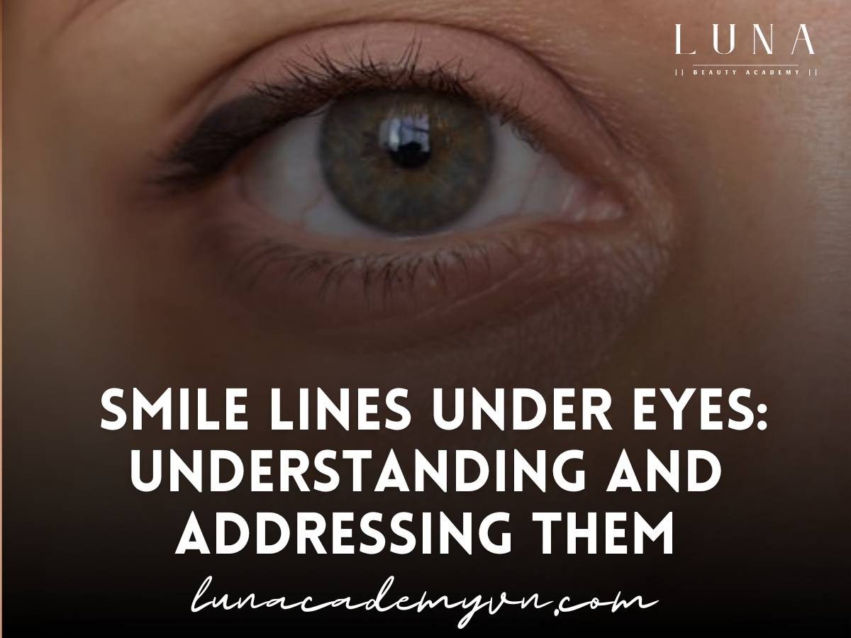 Smile lines under eyes