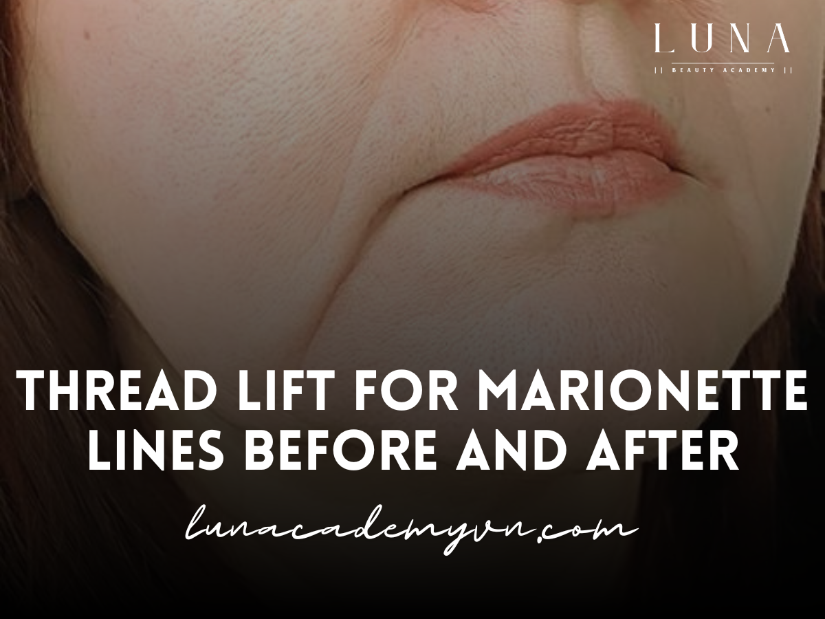 thread lift marionette lines before and after