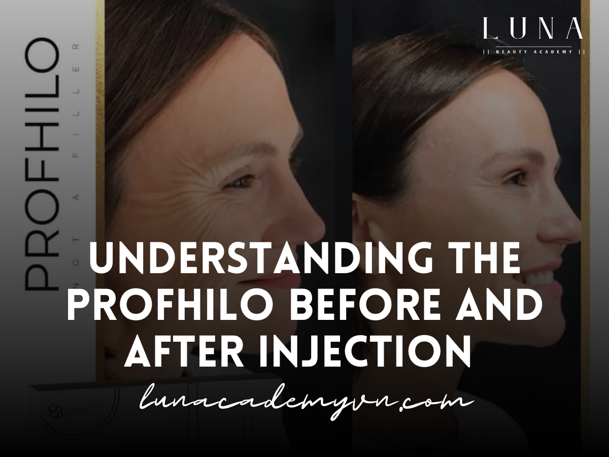 Understanding the Profhilo before and after injection