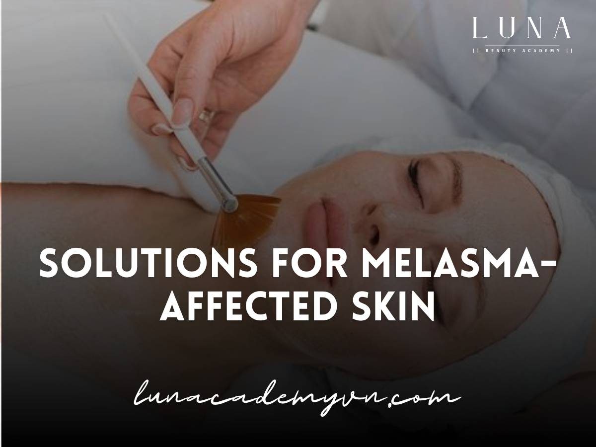 melasma