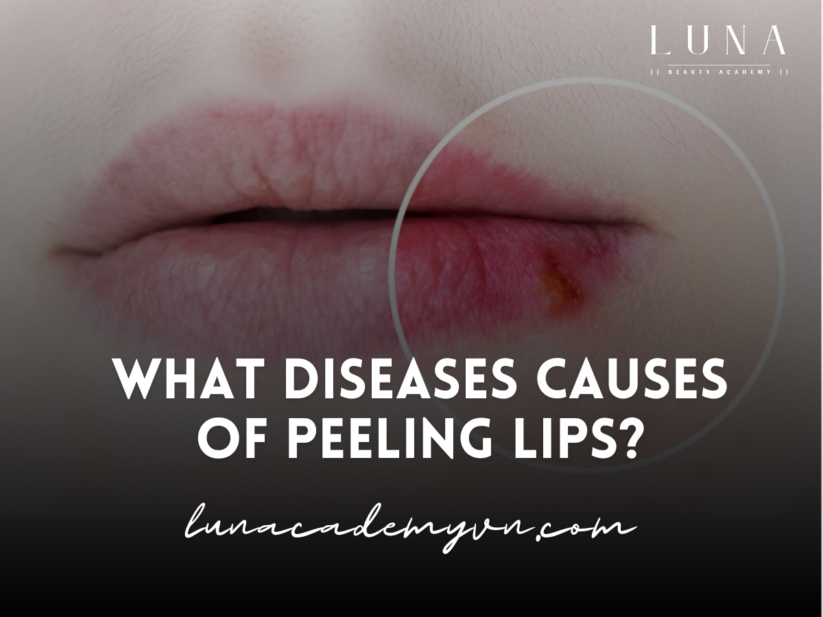 What diseases causes of peeling lips?