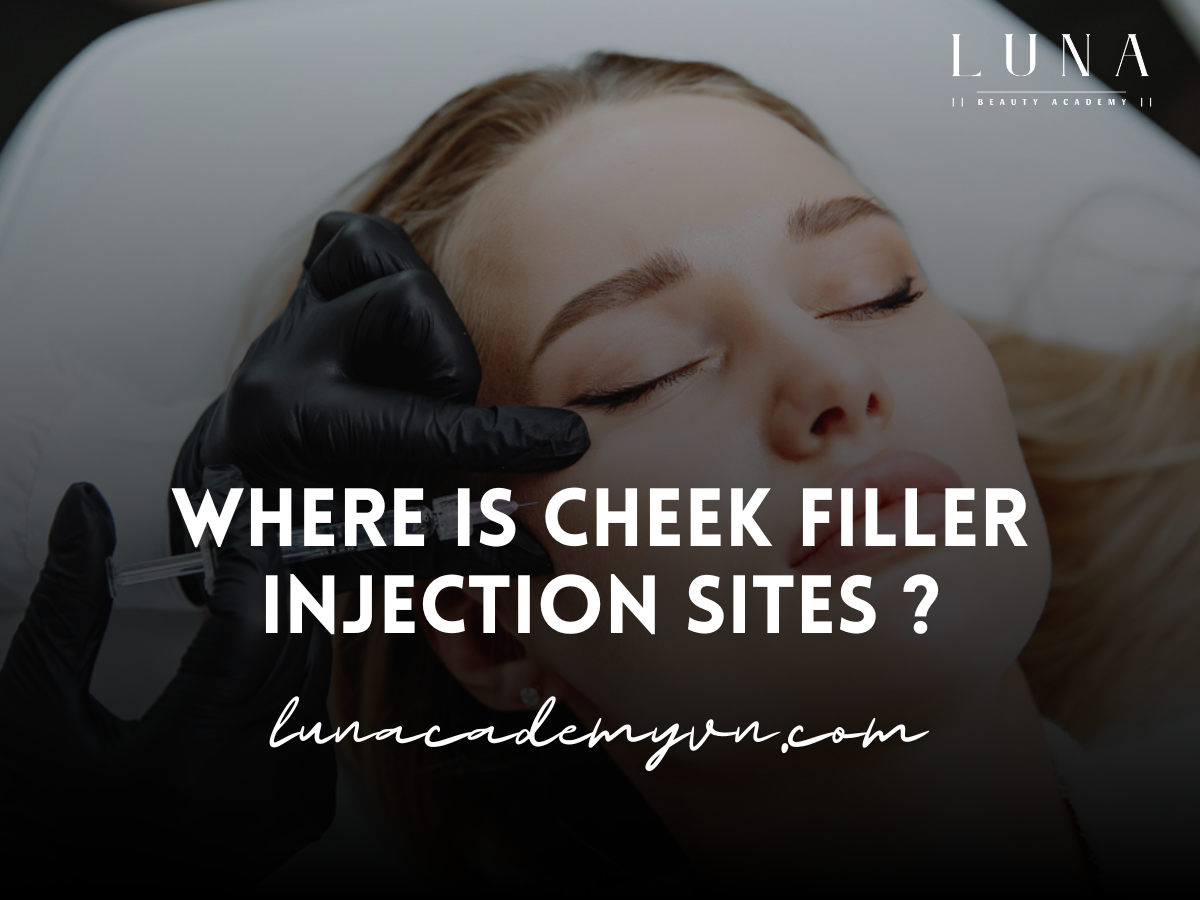 Where is cheek filler injection sites ?