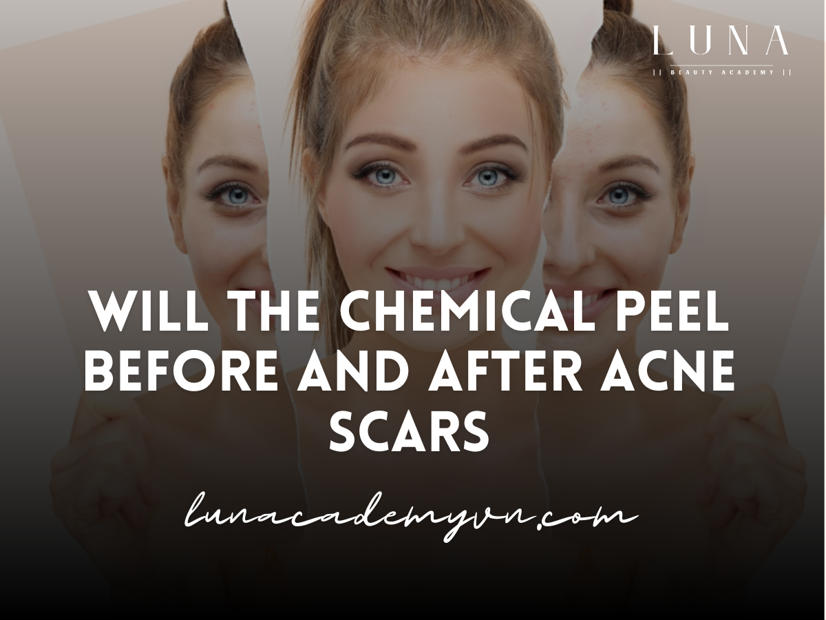 Will the chemical peel before and after acne scars